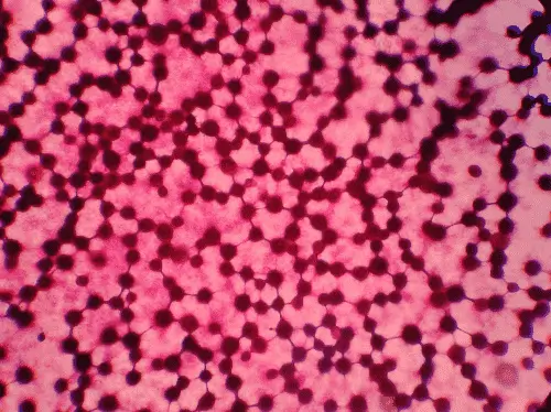 Positive blood culture of Cryptococcus neoformans (Gram stain)